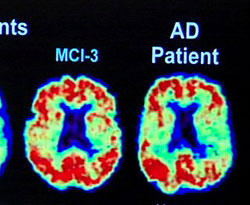 Alzheimer Symptoms Reversed With Stem Cells