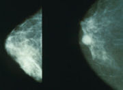 mammo_breast_cancer.jpg