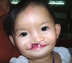 girl with cleft mouth