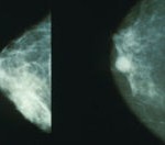 mammo_breast_cancer.jpg