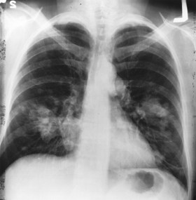 lung-cancer x-ray, National Cancer Institute image