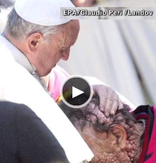 Pope embraces disfigured man