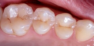 FDA-Approval for Drill-Free Cavity Care May Be Imminent After Great Phase 3 Treatment Trial