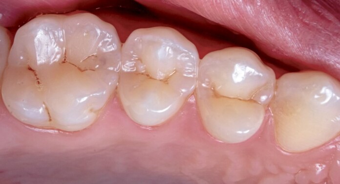 Teeth dentist caveties by Ozkan Guner-lQNl2Vdn0fs-unsplash