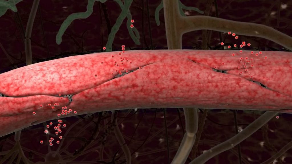 artist rendering blood vessel leaking