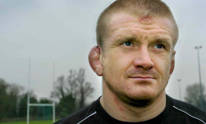 Cauliflower Ears-SWNS