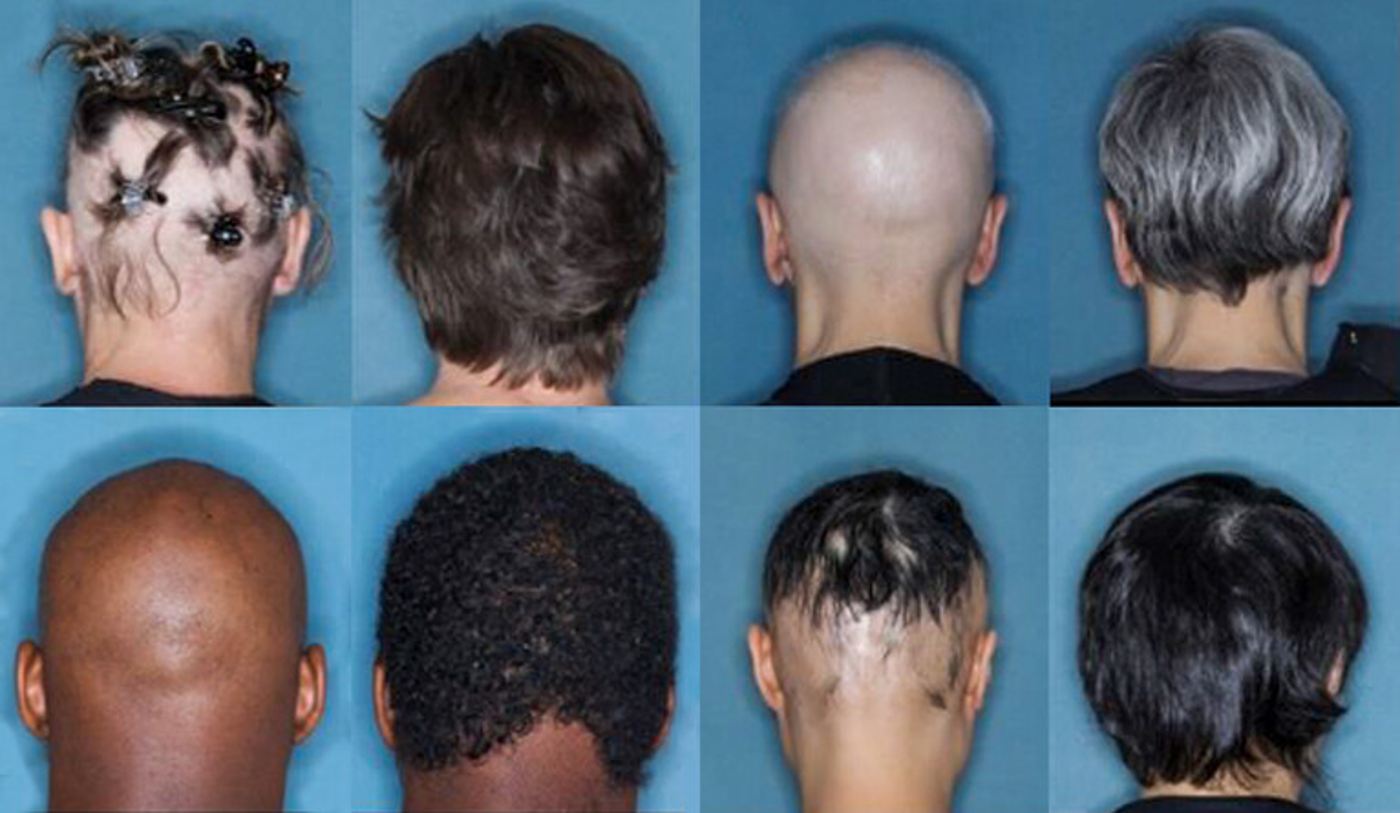 Perawatan Baru Membantu Pasien Alopecia Menumbuhkan Rambutnya