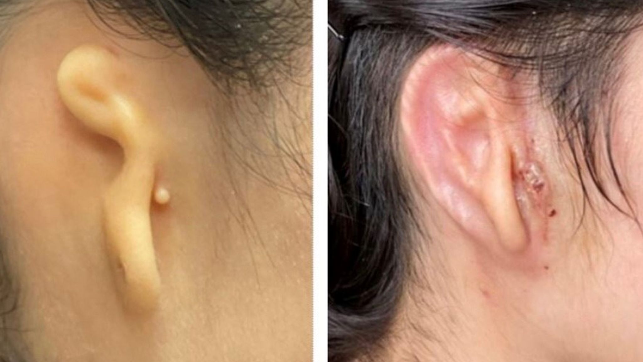 Telinga yang Dicetak 3D Dibuat dan Ditransplantasikan Dari Sel Hidup Pasien