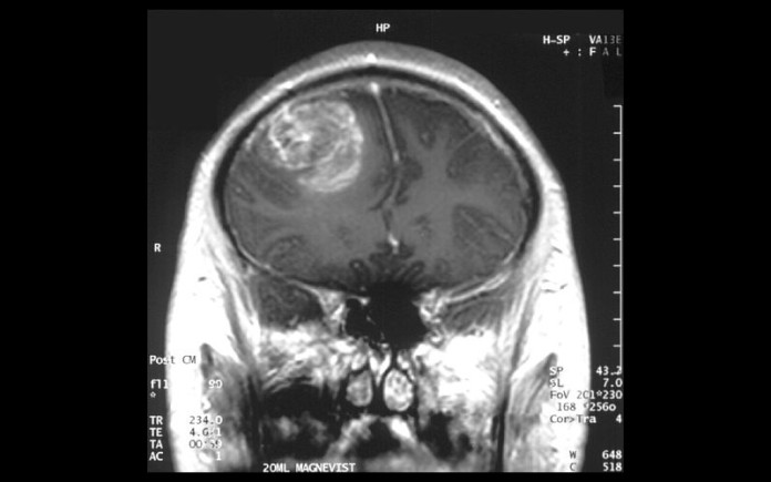 MRI of Glioblastoma - CC 2.5. Christaras A