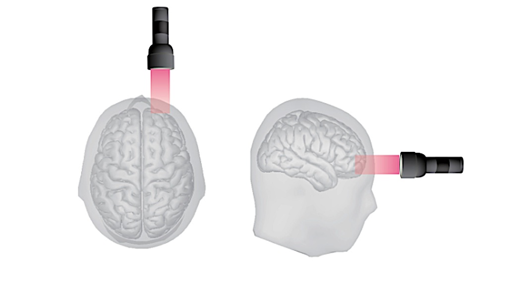 Ingatan Jangka Pendek Dapat Ditingkatkan Dengan Terapi Sinar Laser Non-Invasif yang Menunjuk Otak Manusia