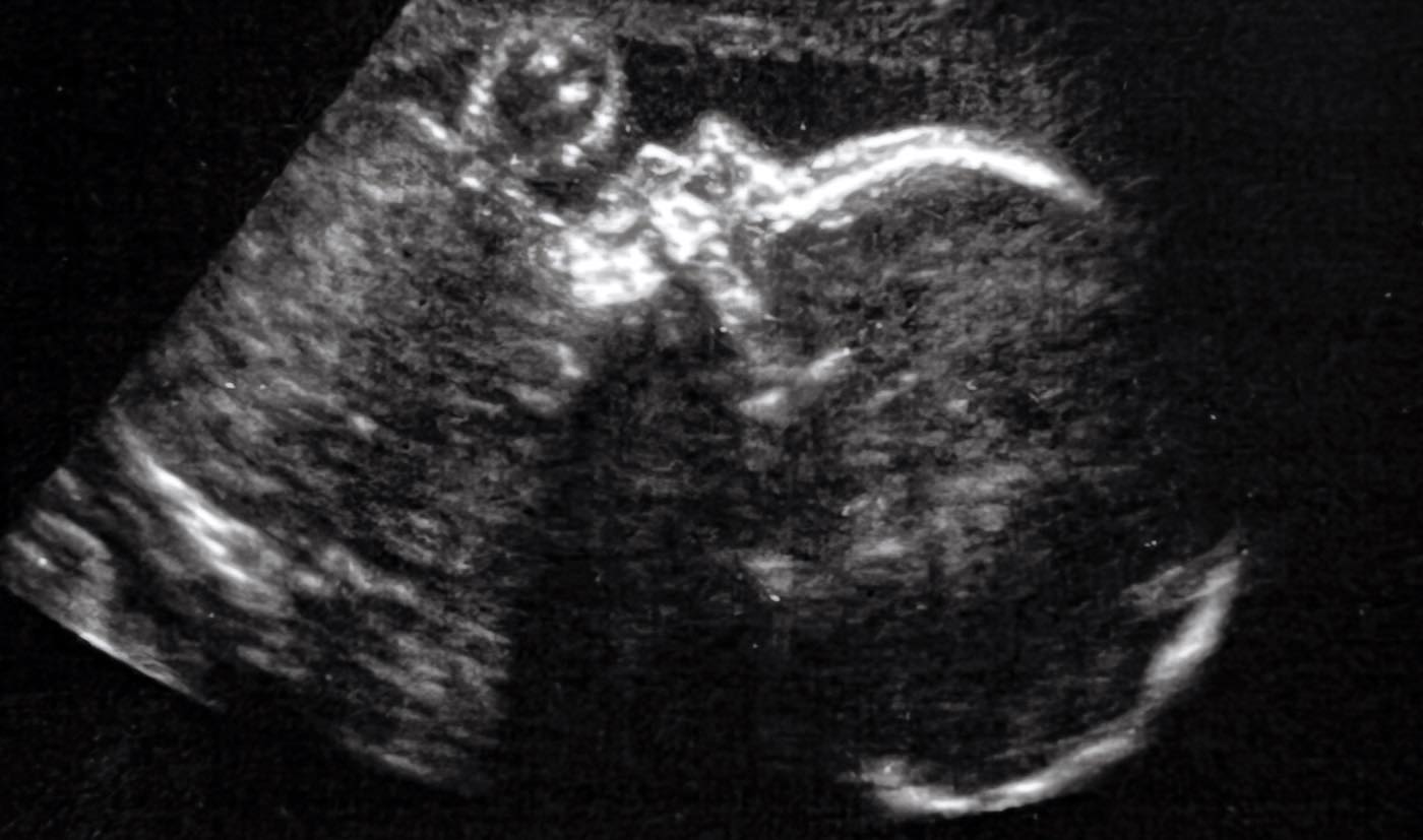 healthy fetus baby ultrasound SWNS