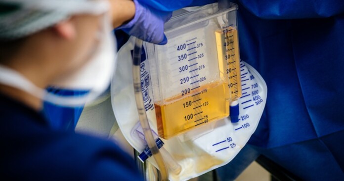 UAB nurse measures urine output from transplanted genetically modified pig kidney-released By Steve Wood