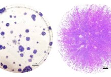 Stem Cells in Menstrual Blood Have Thrilling Potential for Health, Including Diagnosing Endometriosis
