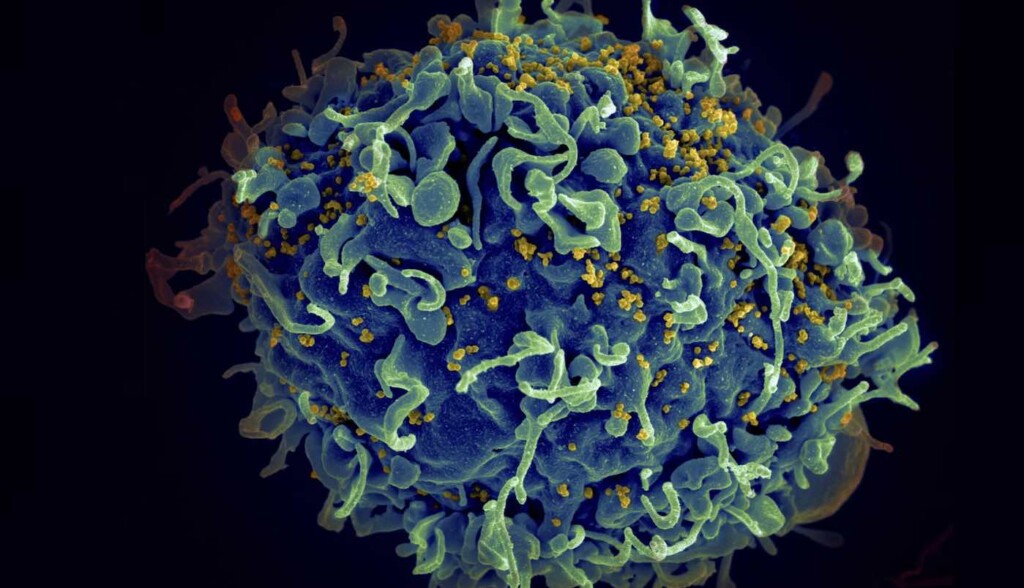 HIV AIDS virus (in yellow) infecting a human cell – Credit: National Cancer Institute
