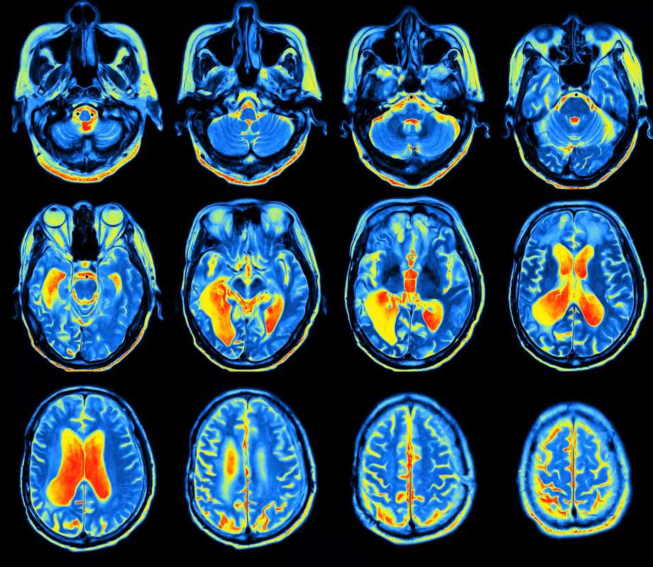 A Selection Of Brain Mris Credit Mriman