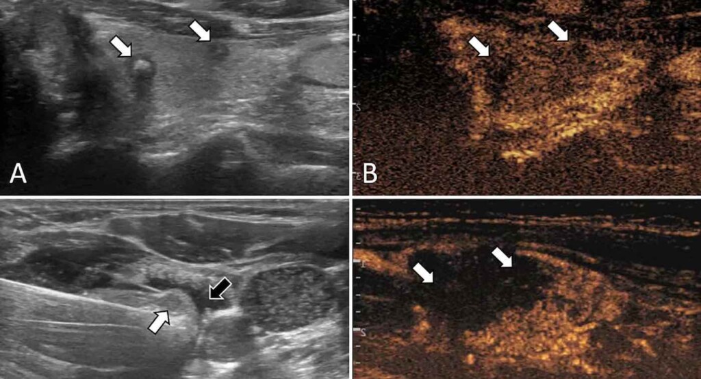 Ultrasound Images Of Thyroid Cancer Tumor Treatment China Japan Friendship Hospital in Beijing Swns