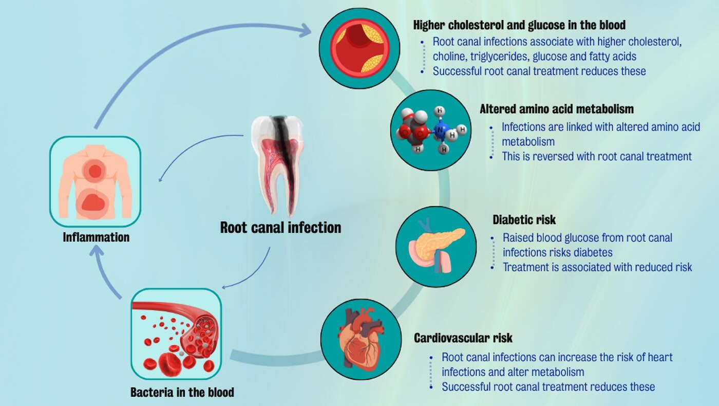 Root Canal Treatment Reduces Heart Disease And Diabetes Risk