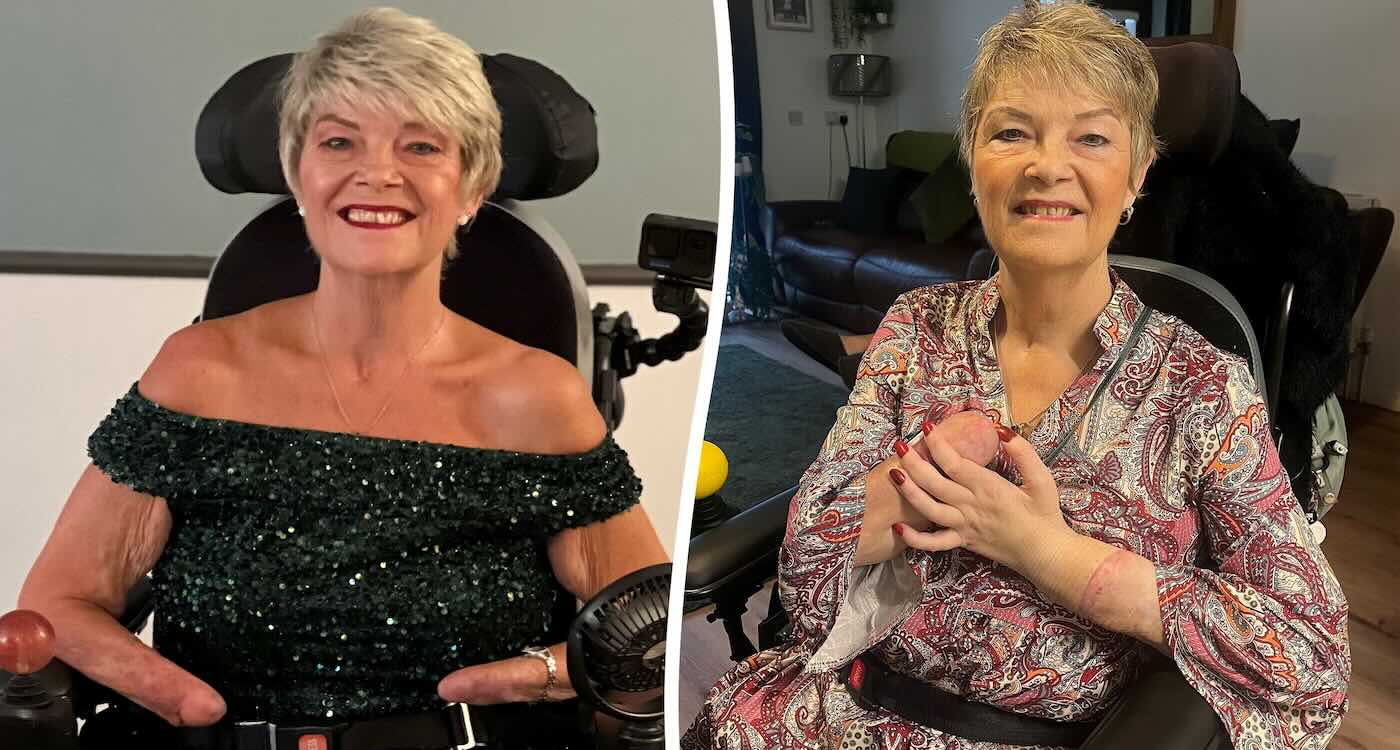 Amputee Thrilled With Hand Transplant is Now Left-handed: ‘Feels so incredible, as if I’ve had it my whole life’