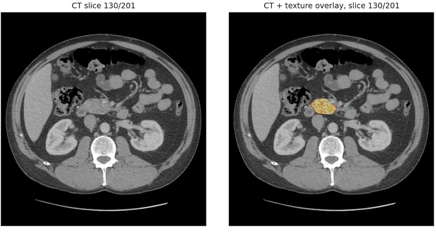 MAYO CLINIC AI SPOTS PANCREATIC CANCER THREE YEARS EARLY