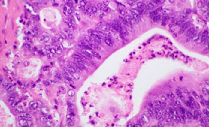 An image of pancreatic cancer - credit, PLOS ONE 11(3) -DOI10.1371journal.pone.0150338 CC 4.0. Int