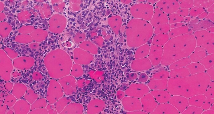 Microscope view of deficient muscle tissue due to dystrophin gene-Courtesy Binghamton University