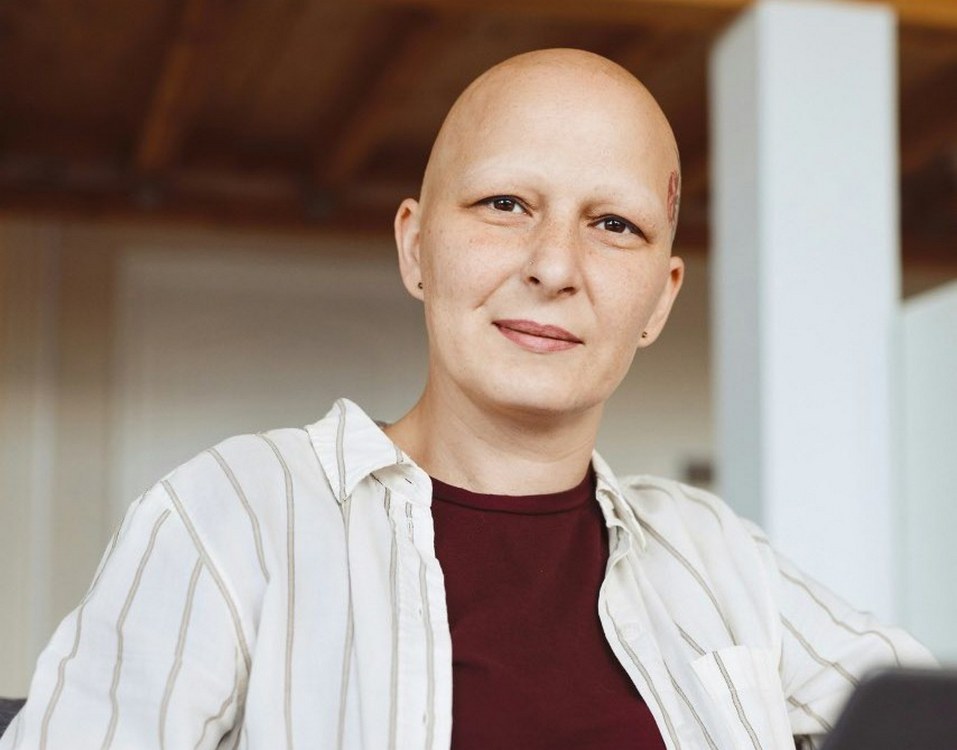 Arthritis Drug Demonstrates Substantial Hair Regrowth in 1,400 Alopecia Patients
